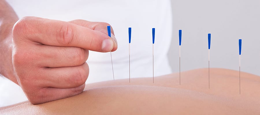 acupunctura